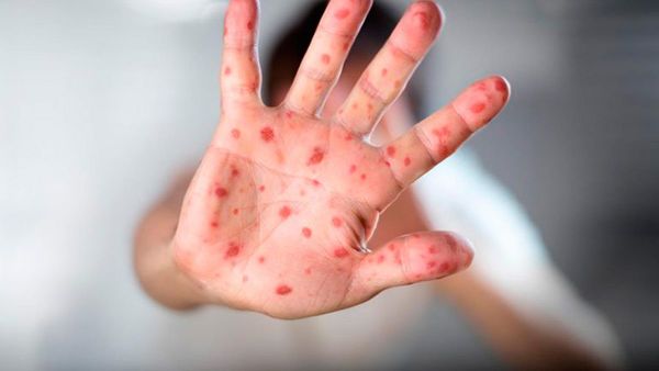 Salud lanza campaña de vacunación contra el sarampión, polio y rubéola