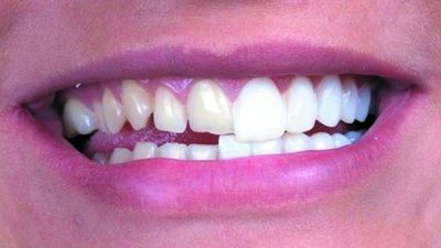 Se tunean los dientes como los influencers