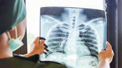 Covid-19: 34% incrementaría el riesgo de gravedad por cáncer de pulmón