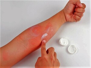 Cuando calienta el sol: Especialistas dan sugerencias para los que padecen dermatitis atópica – La Mira Digital