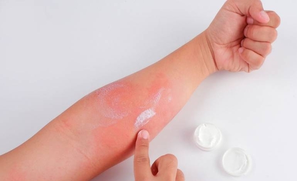 Diario HOY | ¡Cuando calienta el sol! recomendaciones para los que padecen dermatitis atópica
