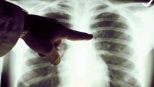 Diario HOY | La medicina de precisión, un paso de gigante en la eficacia contra el cáncer