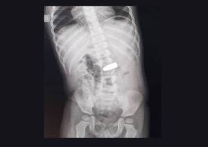 Crónica / ¡TRAGÓ BALA DE 9 MM! Proyectil quedó en la barriga de un bebé