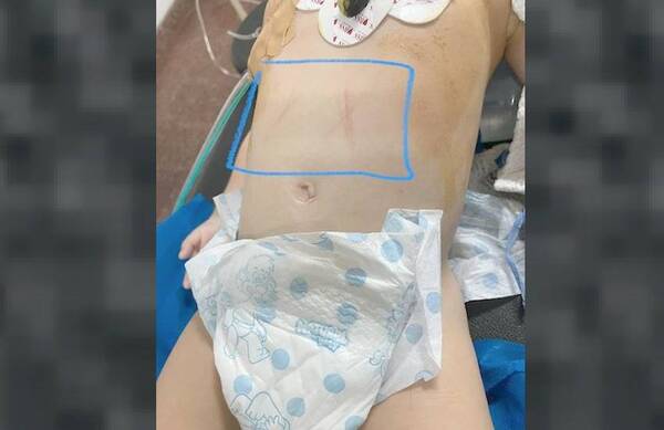 Crónica / PENSARON QUE ERA ¿PY’A RURU? Niña casi muere de neumonía