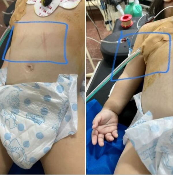Niña termina intubada y en UTI por neumonía: Médico naturalista trató ‘py’a ruru’, denuncian