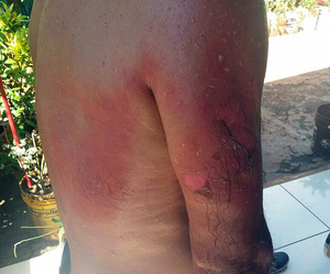 Mujer derramó aceite hirviendo a su expareja - Noticde.com