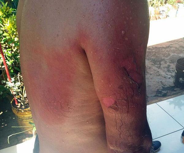 Mujer derramó aceite hirviendo a su expareja - Noticde.com