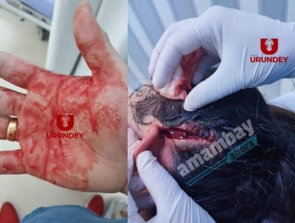 Mujer fue herida con una piedra en el partido Amambay vs. Horqueta