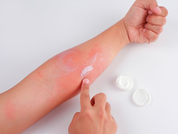 Especialistas dan recomendaciones para los que padecen dermatitis - El Independiente