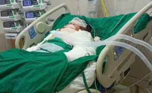 Confirman fallecimiento de joven que habría sido quemado por su novia