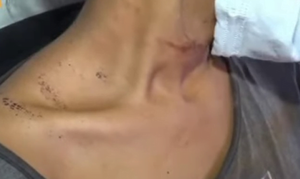 Brutal agresión a una mujer: le quemaron con un cigarrillo y le sacaron la uña - Noticiero Paraguay
