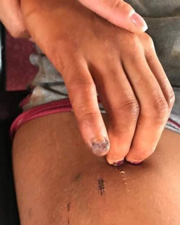 Crónica / Agarraron al joven que le sacó las uñas ndaje a su pareja
