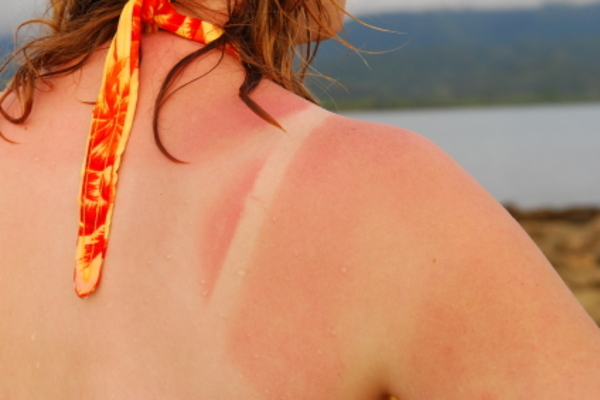 Salud Pública recomienda cuidar la piel durante el verano para evitar el cáncer - .::Agencia IP::.