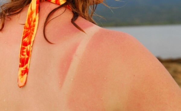 Recomiendan cuidar la piel del intenso calor para evitar el cáncer
