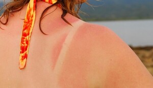 Verano: Recomiendan cuidar la piel para evitar el cáncer - La Clave