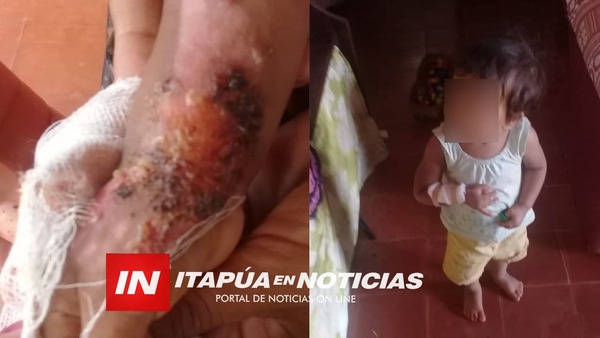 BEBÉ CON QUEMADURAS NECESITA ASISTENCIA. - Itapúa Noticias