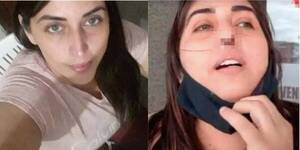 Crónica / Perdió su nariz por culpa de un mal hisopado he'i