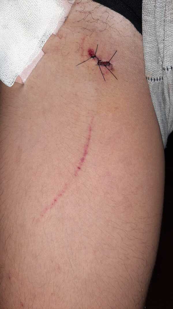 Apuñalan en el muslo a un menor de edad en Otaño