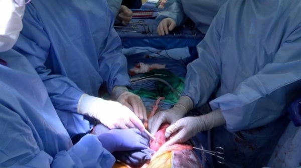 Diario HOY | Trasplantan dos riñones de cerdo modificados genéticamente a un humano