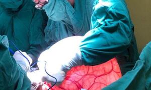 Extraen tumor de 15 kilos del ovario de una mujer en el Hospital Nacional – Prensa 5