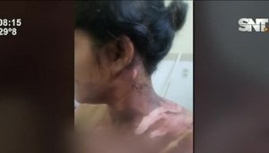 Habría sido golpeada y quemada por su pareja - SNT
