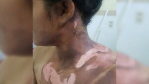 Sospechan que quemó a su pareja: La joven está en terapia intensiva