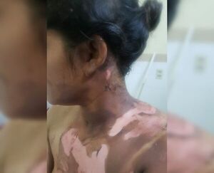 Sospechan que quemó a su pareja: La joven está en terapia intensiva