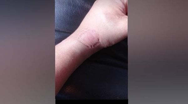 Diario HOY | Una mujer mordió a un policía tras una riña