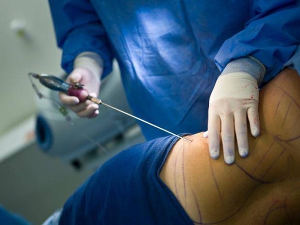 Diario HOY | Cirugía estética: Pacientes deben guiarse por el "triángulo de seguridad"