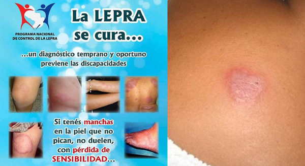 LEPRA: DETECCIÓN OPORTUNA ES CLAVE PARA UN TRATAMIENTO PROACTIVO - Itapúa Noticias
