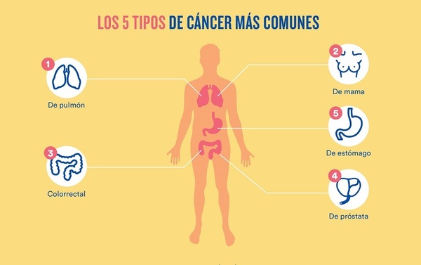Cáncer: Insisten en la detección precoz para mejor tratamiento - ADN Digital