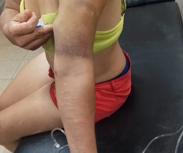 Derramó aceite caliente a su pareja