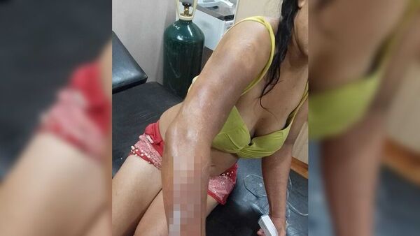 Le derramó aceite caliente a su señora y se escapó