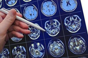 Videograma: qué es la conmoción cerebral - Ciencia - ABC Color