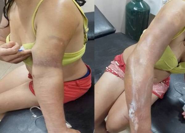 Crónica / "Tilingo" derramó aceite aku a su concubina
