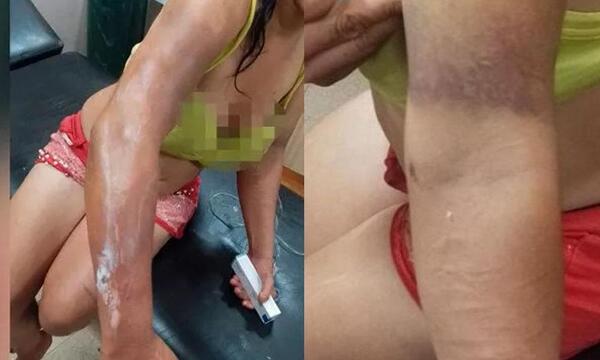 Tras discusión derramó aceite caliente a su pareja en Alto Paraná – Prensa 5