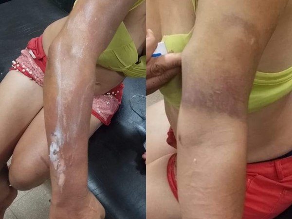 Hombre derramó aceite hirviendo a su pareja durante una discusión - Noticiero Paraguay