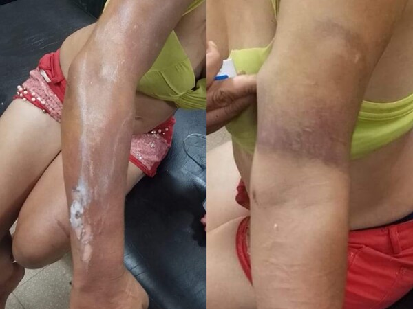 Hombre derramó aceite caliente a su pareja durante una discusión - Noticiero Paraguay