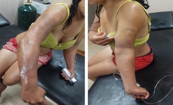 Hombre que derramó aceite caliente a su pareja sigue prófugo