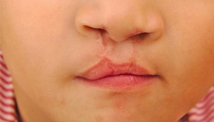 Anuncian cirugías reconstructivas a niños con labio y paladar hendido en Clínicas