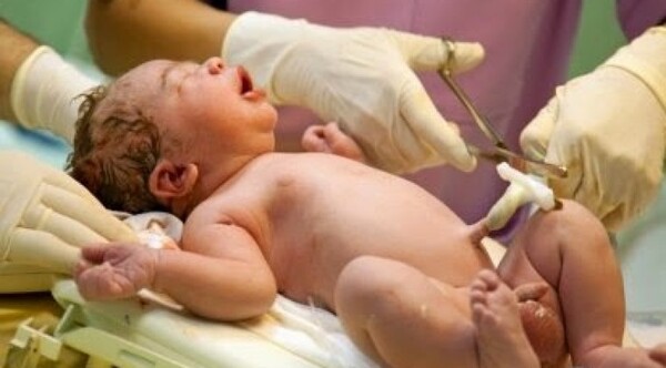 Ligadura oportuna del cordón umbilical, recomendada para todos los nacimientos