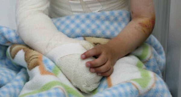 Crónica / Criatura se quemó mientras su hermana cocinaba tortilla y un "ángel" le salvó