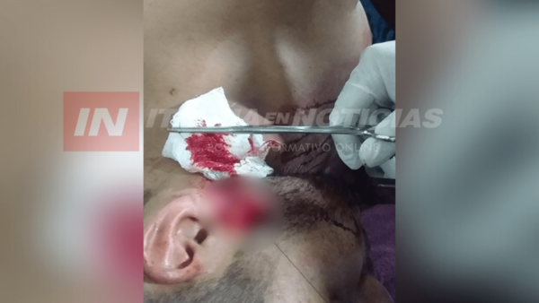 FUE AL VOLEY Y TERMINÓ CON UN BOTELLAZO EN LA CABEZA - Itapúa Noticias
