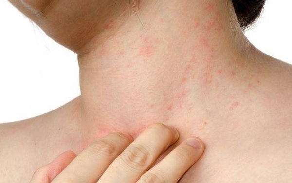 Diario HOY | Humo de incendios puede ocasionar dermatitis atópica