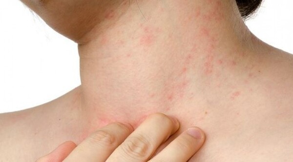 Humo de incendios puede ocasionar dermatitis atópica