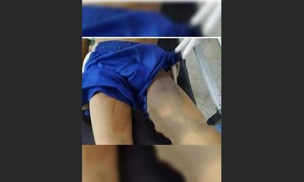 Con una "oración", pastor sanaría a niño mordido por una víbora pero perdió la pierna en Amambay – Prensa 5