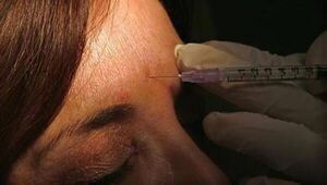 Tratamiento antiarrugas: Advierten sobre “botox” de origen ilegal - Estilo de vida - ABC Color