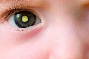 Retinoblastoma: el cáncer de ojos más frecuente en la infancia - Estilo de vida - ABC Color