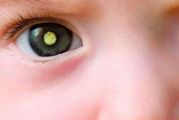 Retinoblastoma: el cáncer de ojos más frecuente en la infancia - Estilo de vida - ABC Color