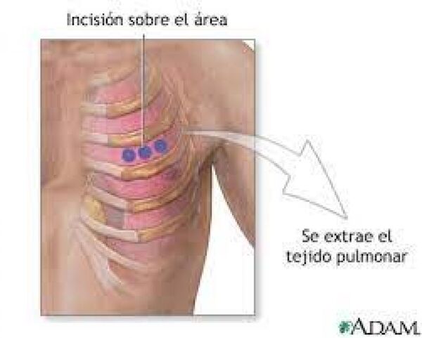 Hospital Regional llevó a cabo primera punción pulmonar - Radio Imperio